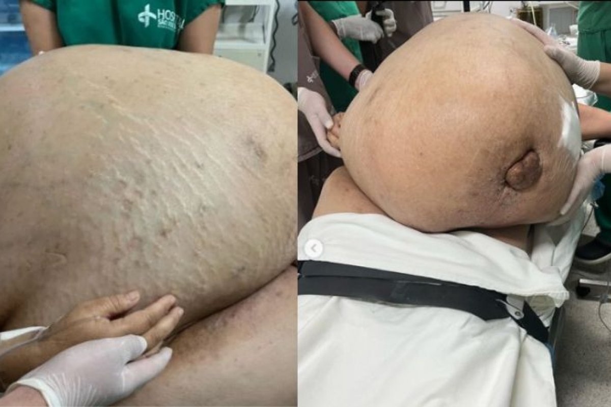 Mulher morre 11 dias depois de ter tumor de 46kg removido, no Rio de Janeiro