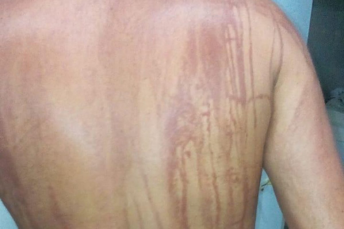 Turista que teve manchas no corpo após banho de mar recebe alta