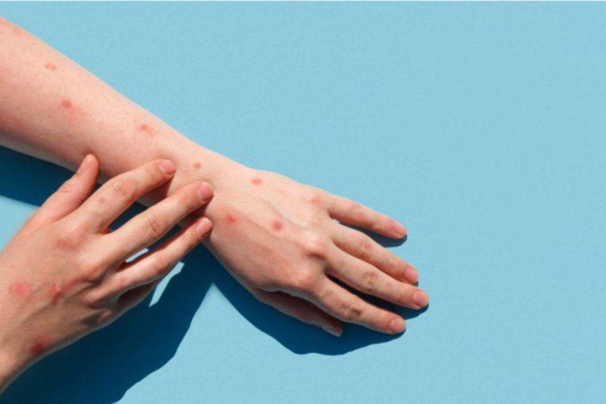 Varíola dos Macacos – dermatologistas falam de lesões na pele que podem confundir o diagnóstico