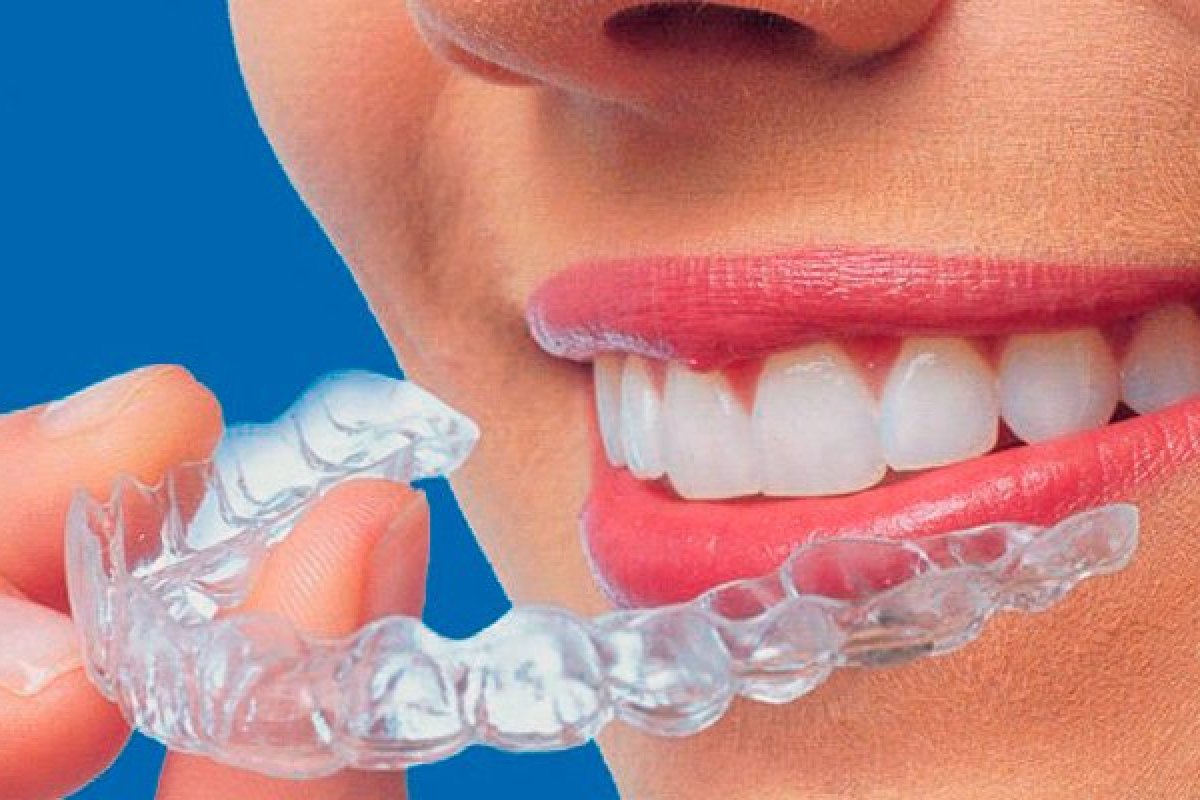 6  indicações de casos para o uso de alinhadores