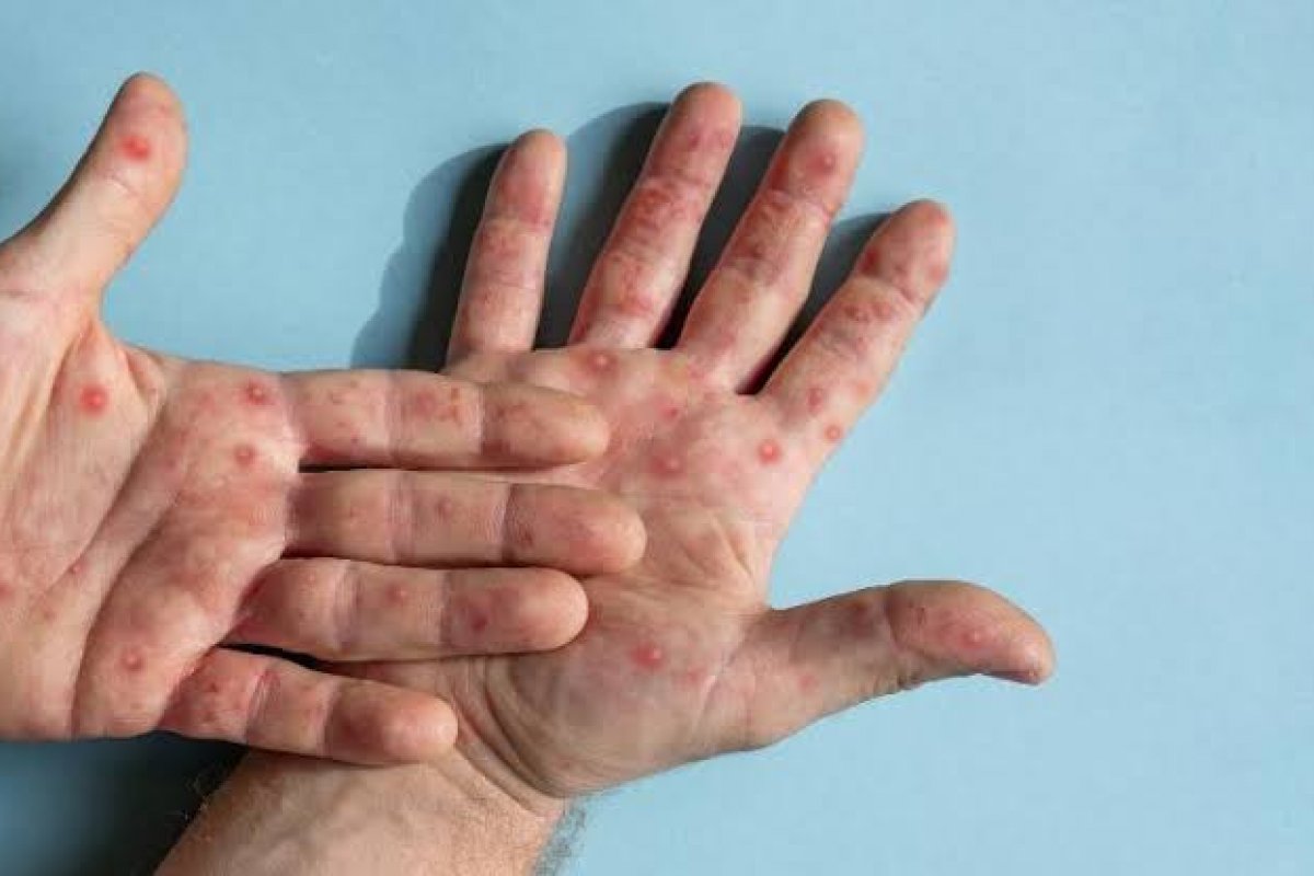 Vacina contra a varíola dos macacos deve chegar ao Brasil este mês