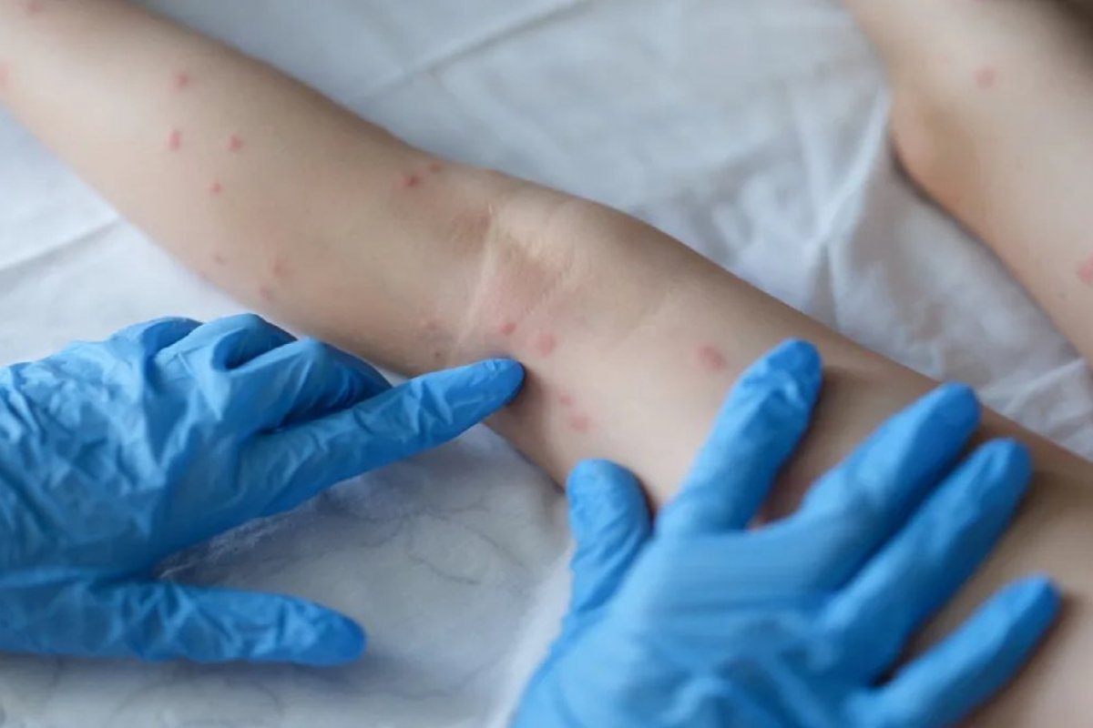 Varíola dos macacos pode causar danos neurológicos, diz pesquisa