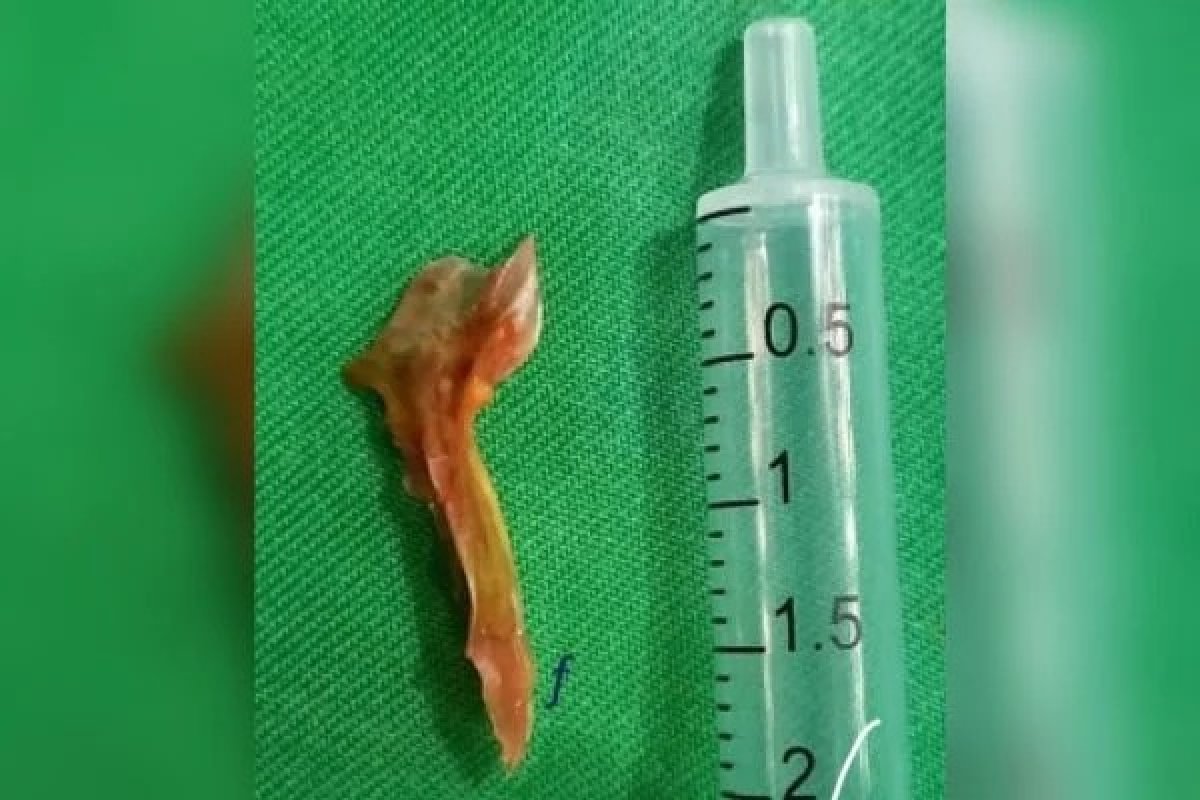 Idoso de 61 anos morre após engolir acidentalmente espinha de 2 centímetros