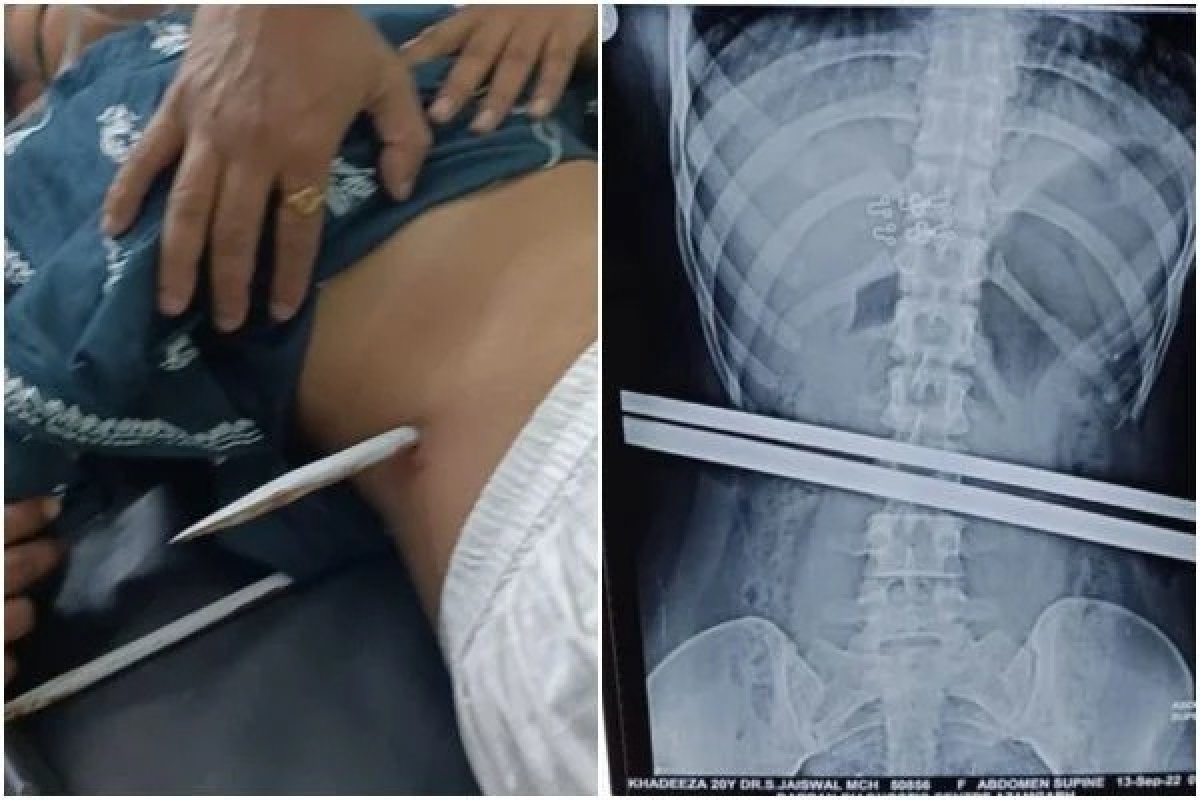 Jovem de 20 anos é transpassada por barra de aço após fugir de macaco