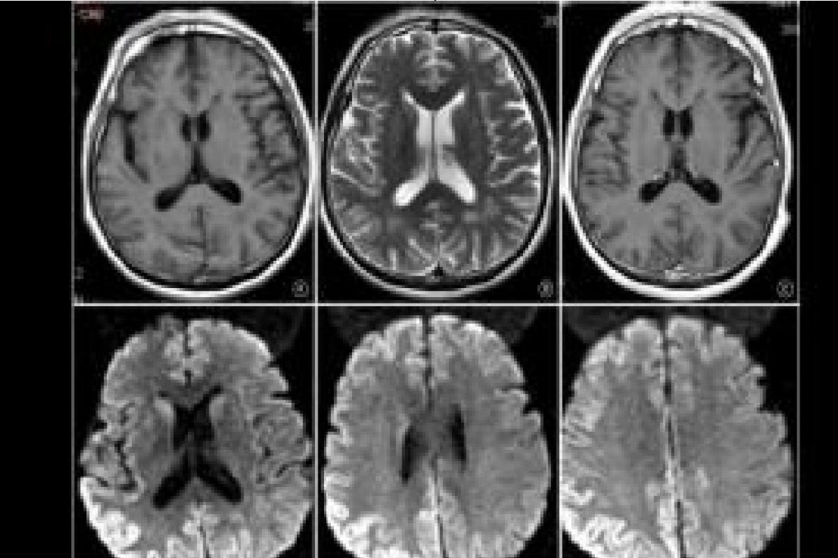 Terceiro óbito decorrente da Doença de Creutzfeldt-Jakob é contabilizado em Salvador