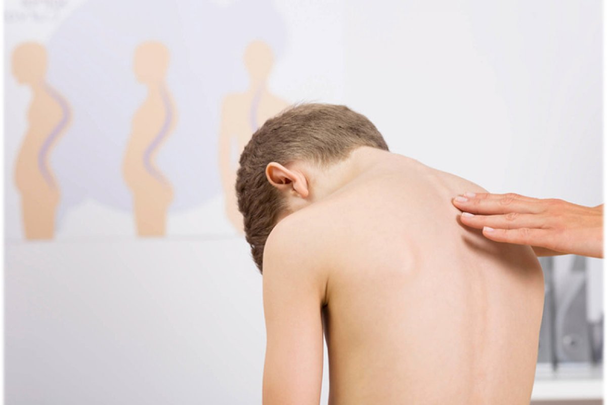 Como identificar e tratar a escoliose em crianças e adolescentes?