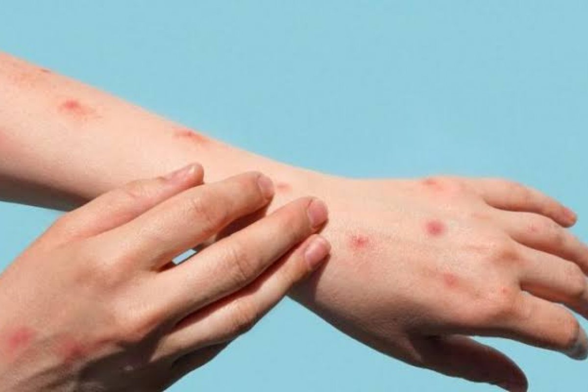 Lacen-Ba identifica 29 diagnósticos positivos de varíola dos macacos