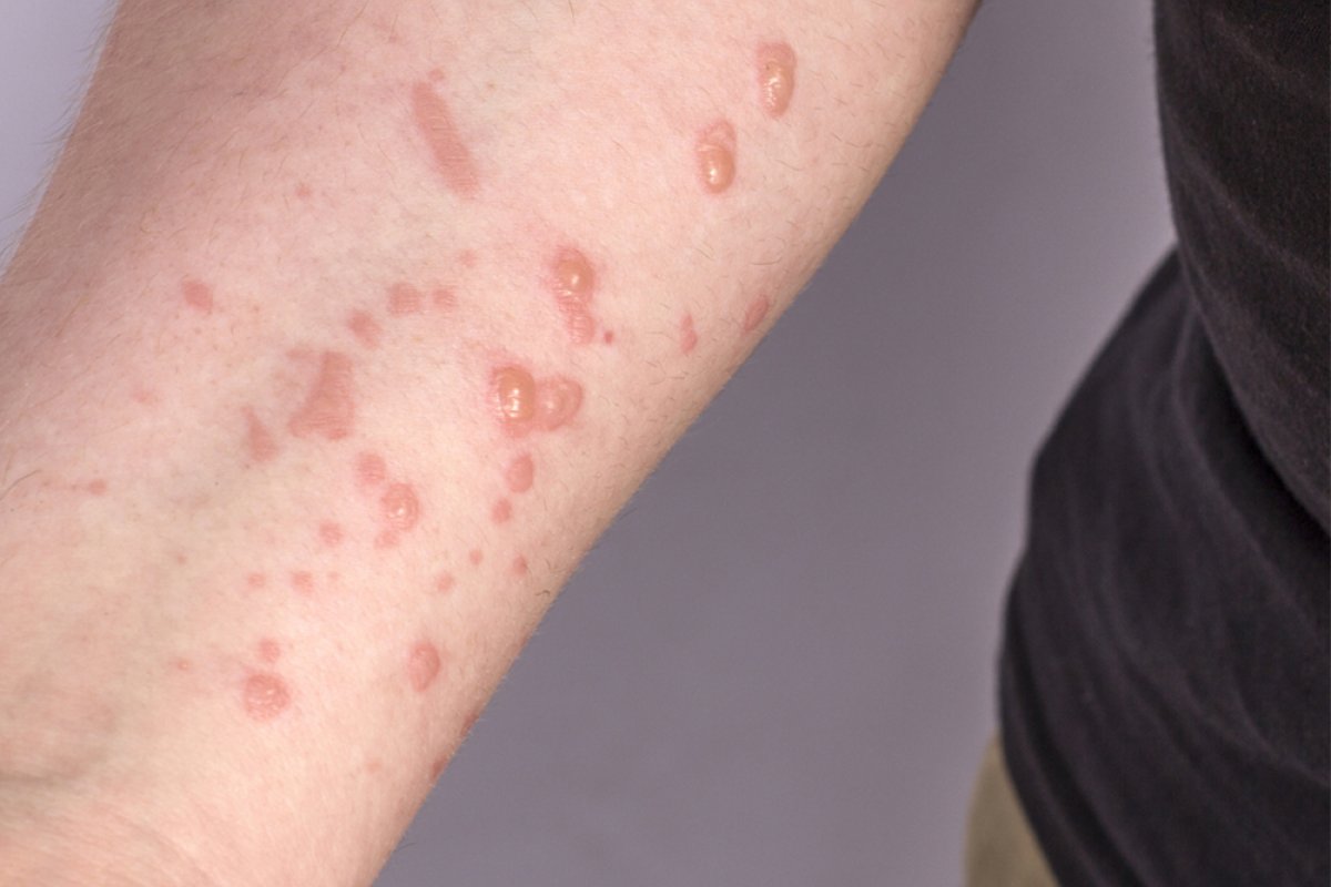 Sesab: Bahia tem 123 diagnósticos de varíola dos macacos