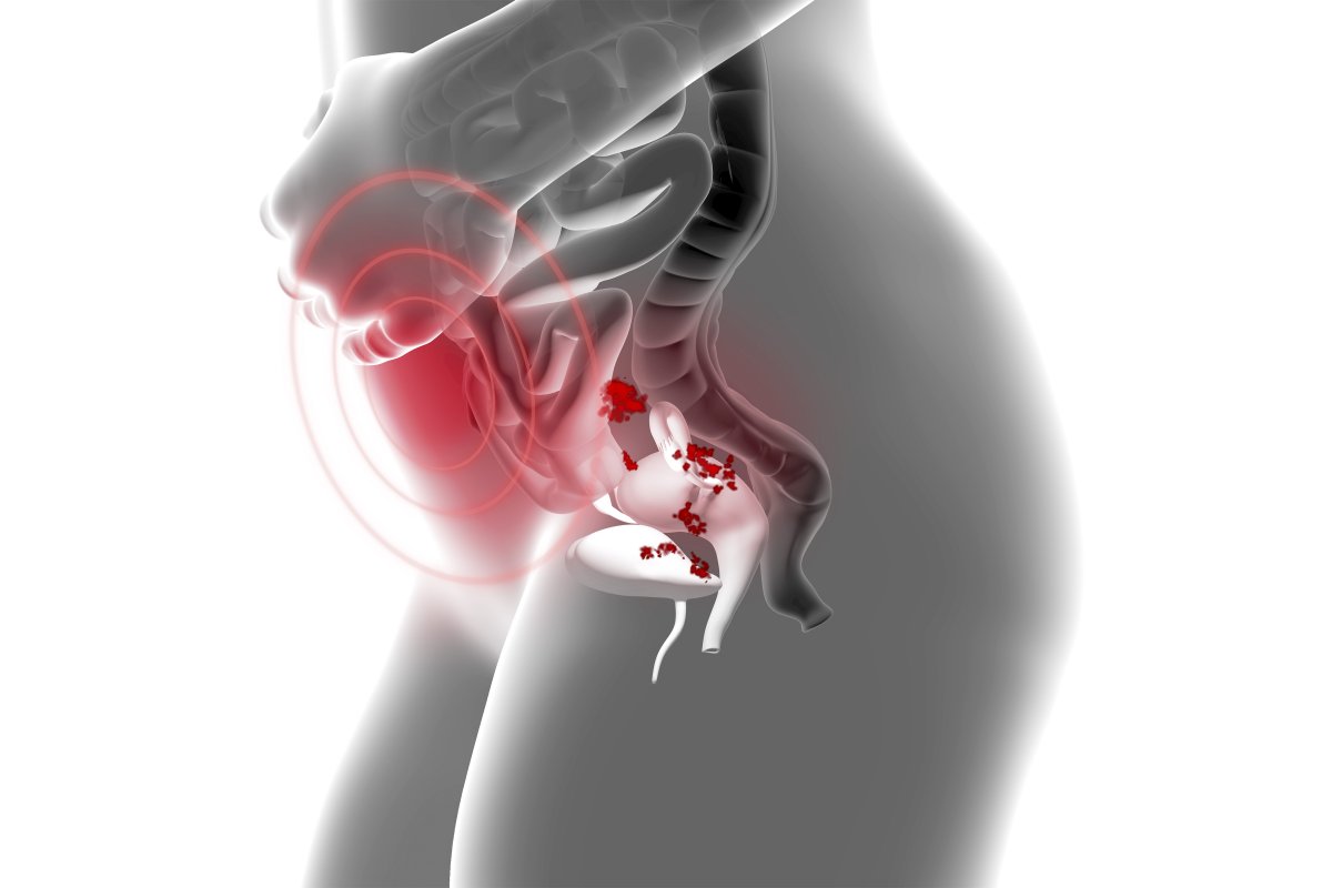 Cirurgia robótica pode ser uma alternativa para casos graves de endometriose