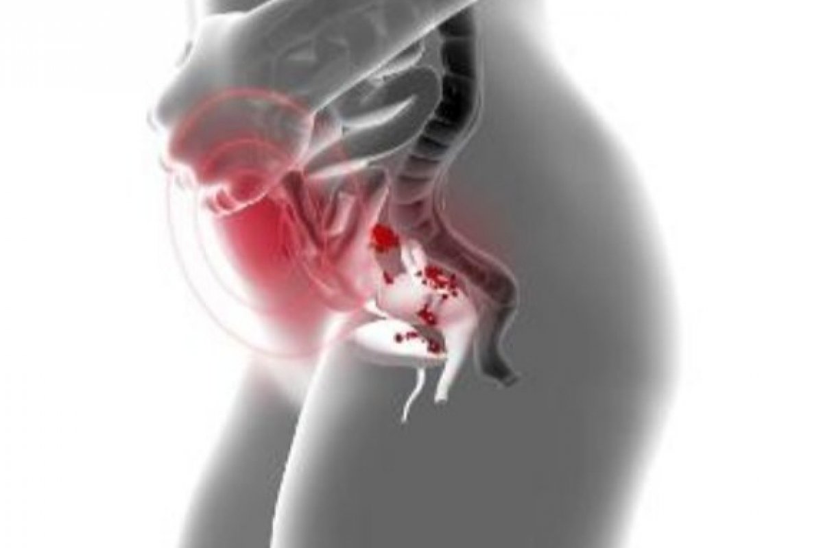 Cirurgia robótica pode ser uma alternativa para casos graves de endometriose! 