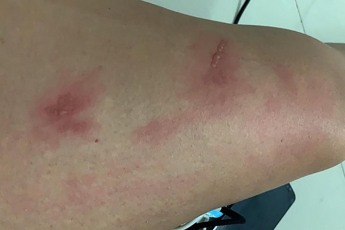 Bahia registra novo caso de possível intoxicação por óleo