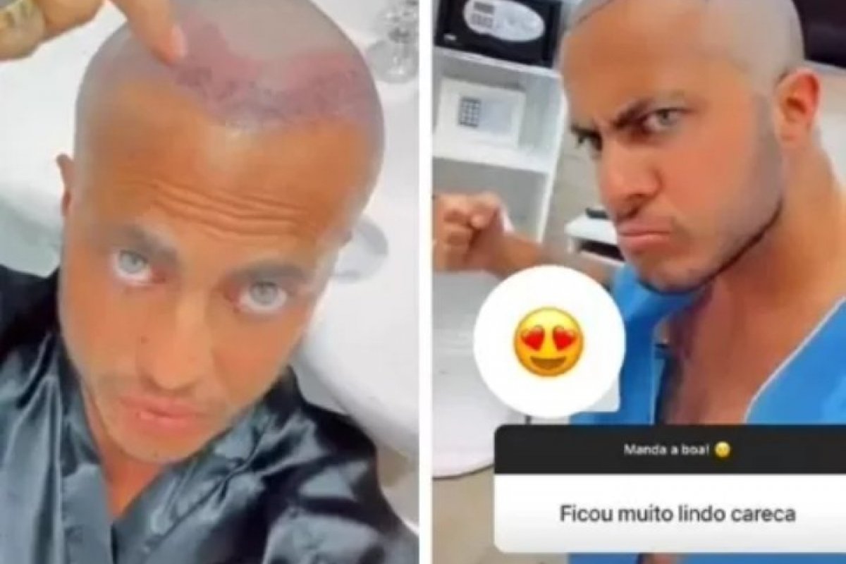 Thammy Miranda faz transplante capilar!