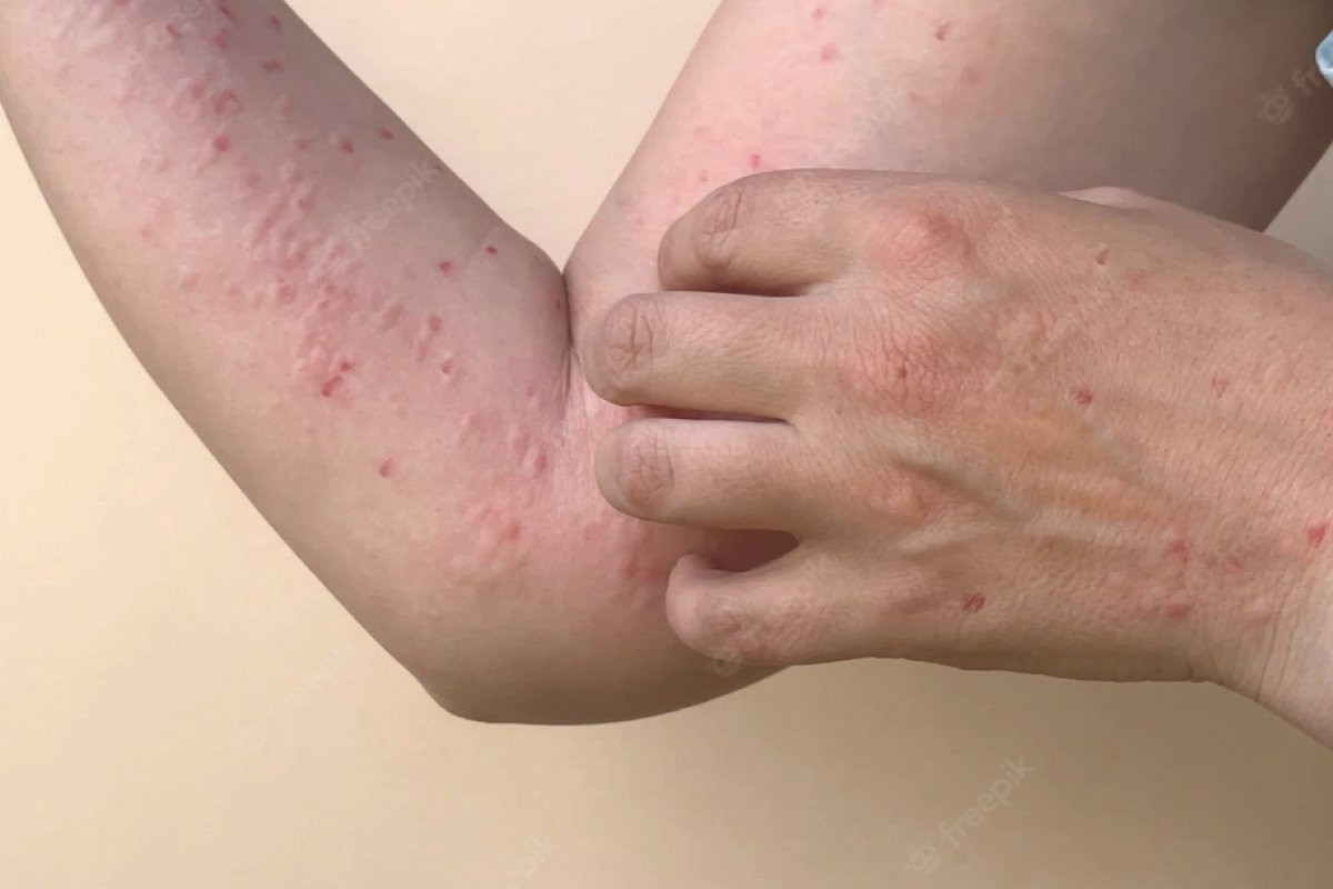 Varíola dos macacos: Sociedade Brasileira de Infectologia recomenda prioridade de portadores de HIV na vacinação