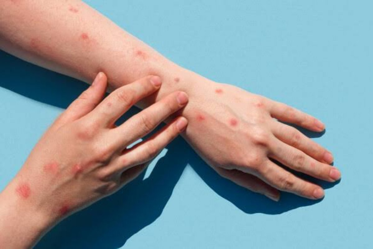 Monkeypox: duas mortes são registrados no Rio de Janeiro