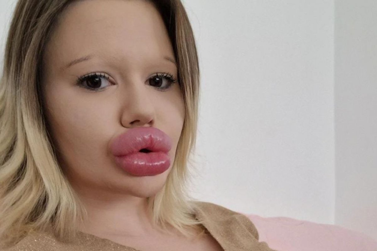 Mulher com 30 preenchimentos labiais ignora risco de morte