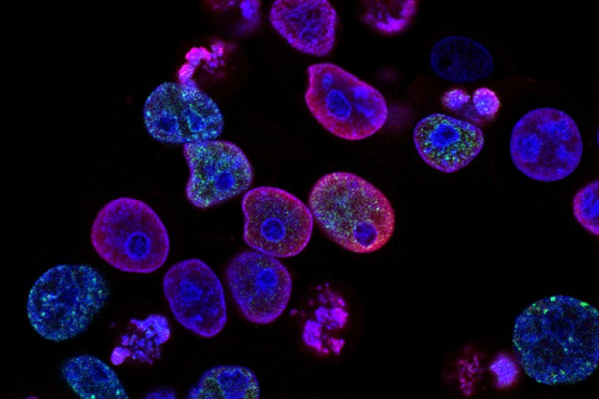 Estudo aponta que Europa pode ter epidemia de câncer na próxima década