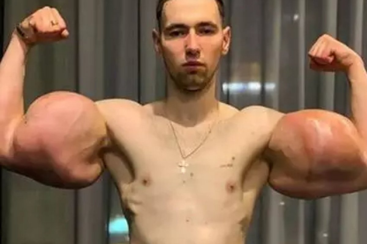 “Popeye” passa por cirurgia e retira 1,36 kg de músculo morto