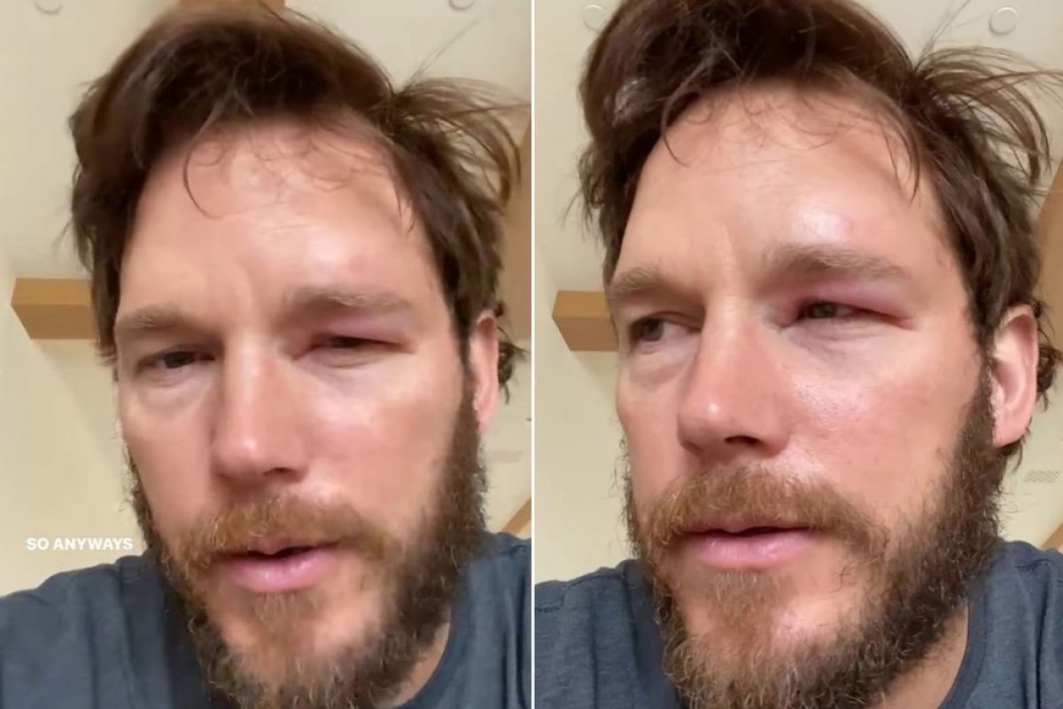 Astro da Marvel aparece com o olho inchado no Instagram após ser picado por abelha