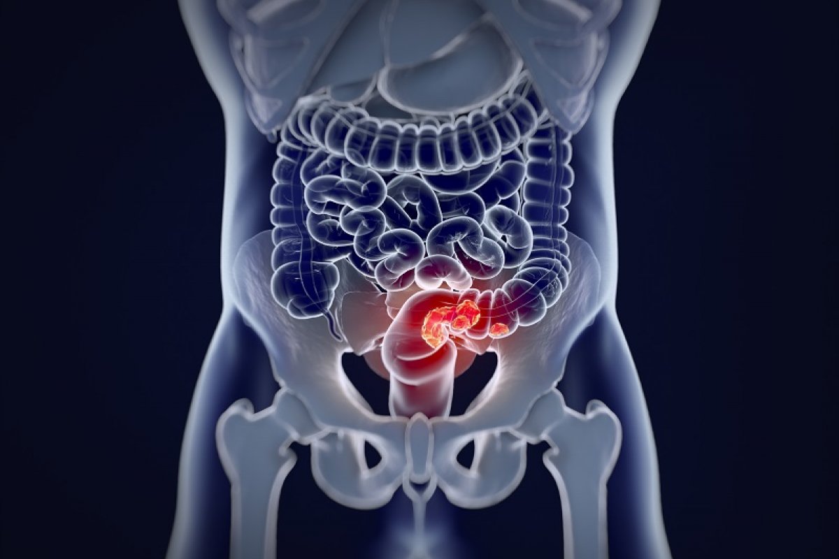 Câncer de Pelé é o segundo que mais mata no mundo!