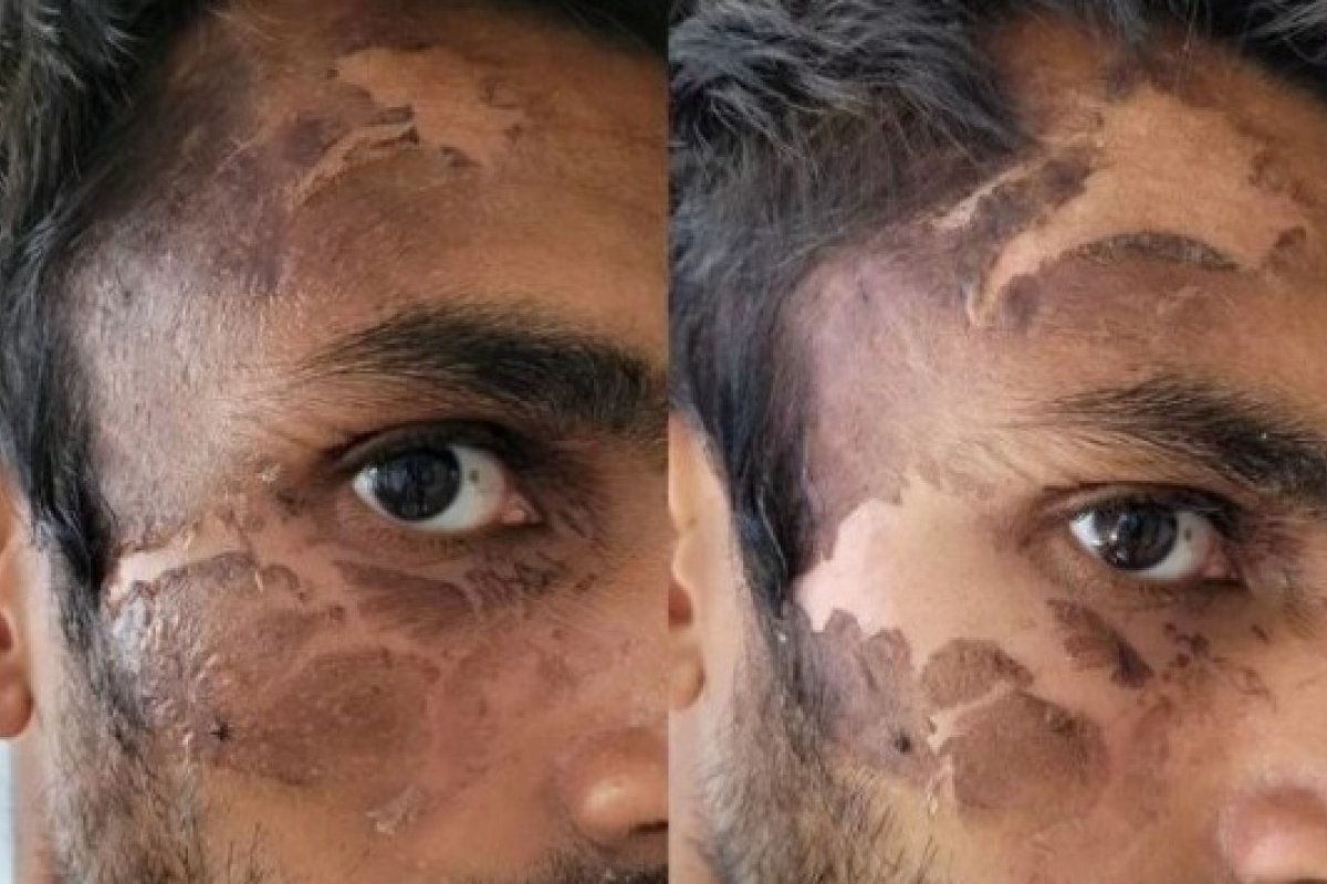 Homem é condenado após jogar água fervente em rosto de policial