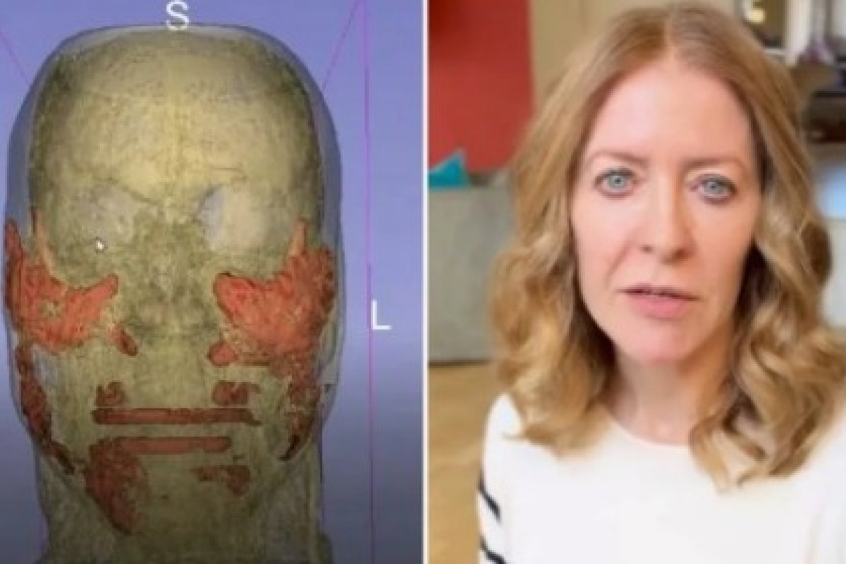Exame revela ácido hialurônico aplicado há 4 anos no rosto de jornalista britânica
