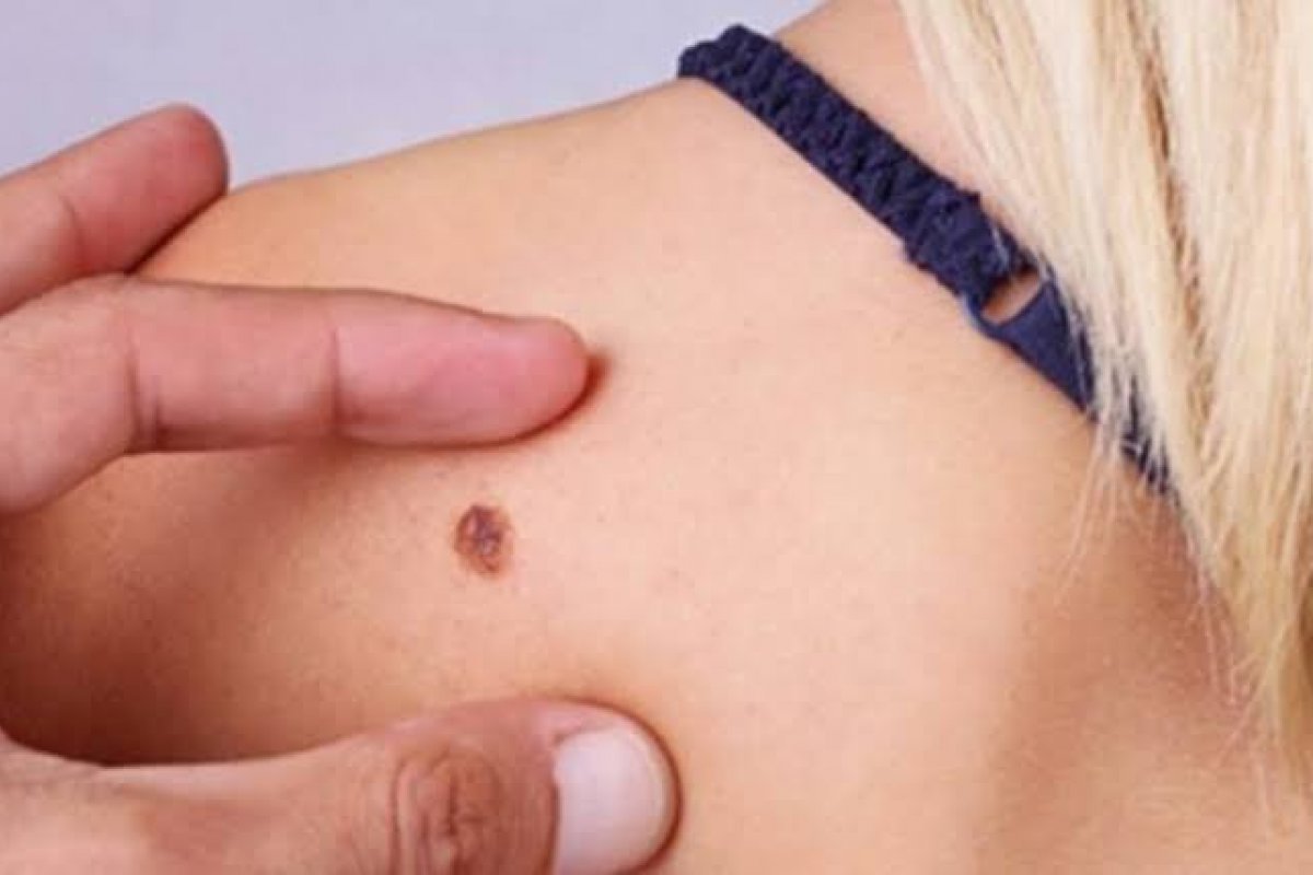 Câncer de pele: Melanoma representa 3% dos casos no Brasil