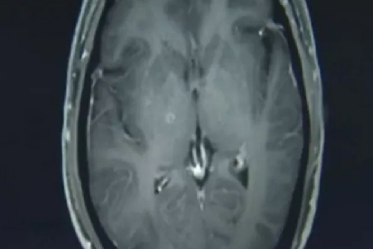 Após ingerir carne de porco, homem fica com mais de 700 larvas no cérebro