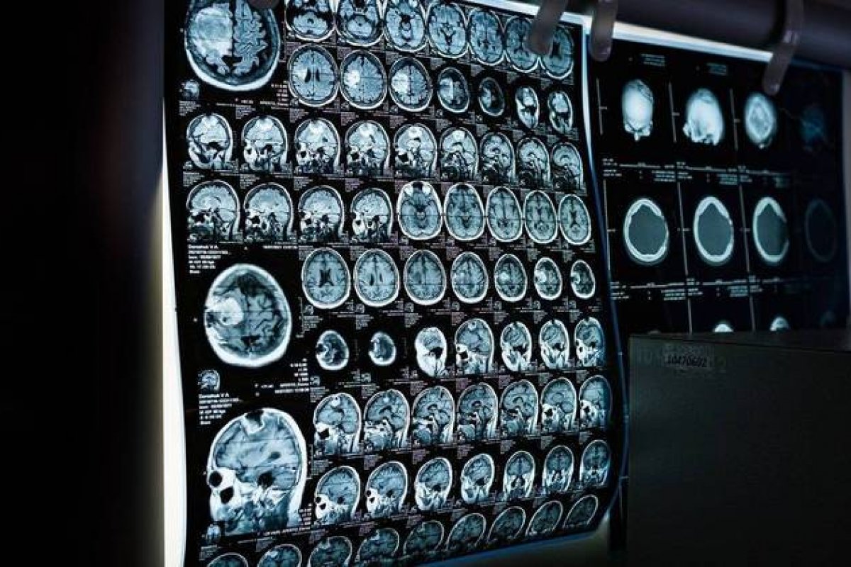 Cérebro de pessoas obesas sofrem níveis parecidos com os de quem tem Alzheimer, diz estudo