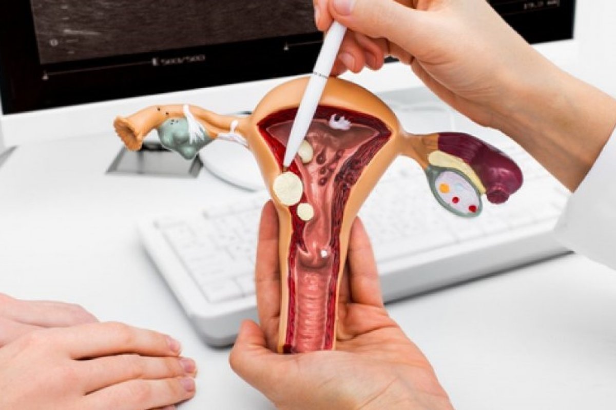 Miomas: especialistas tiram dúvidas sobre condição que afeta 80% das mulheres em idade fértil!