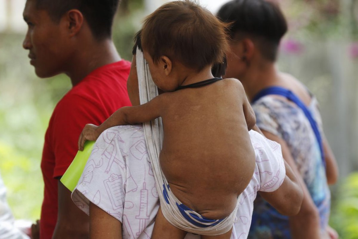 Internação por desnutrição infantil é a maior desde 2012
