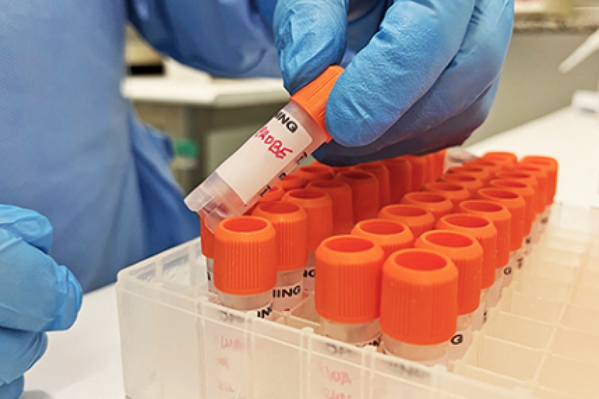 Estudo da Fiocruz analisa evolução da monkeypox em pessoas com HIV