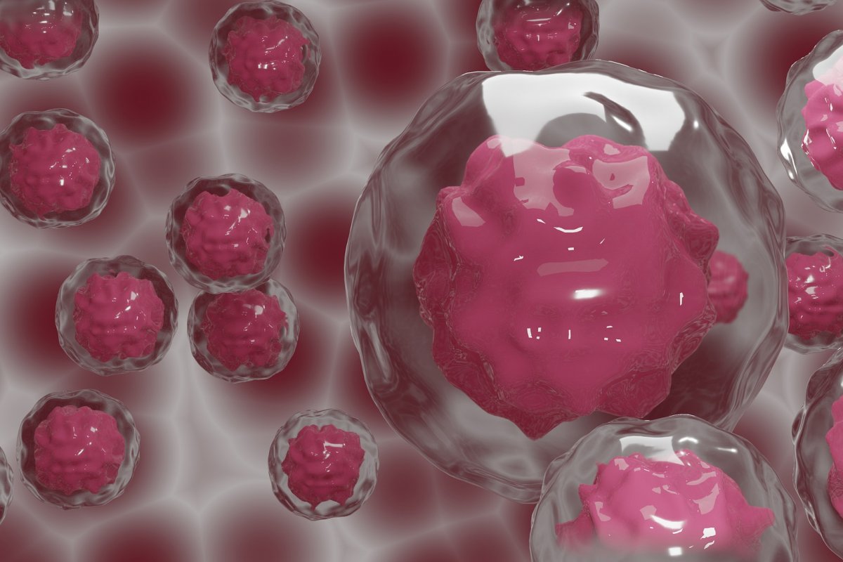 Mulher se livra do HIV após transplante de células-tronco