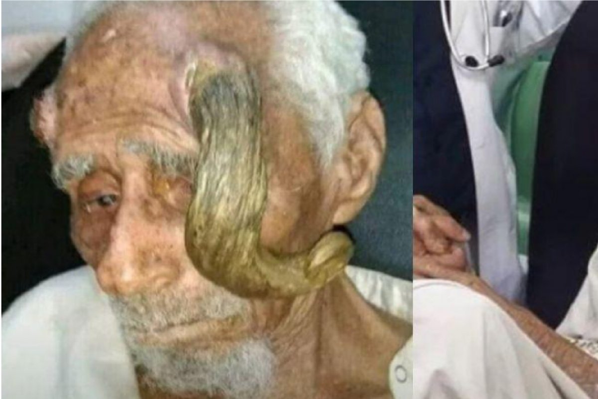 Homem que afirmava ter 140 anos morre após cirurgia para tirar 'chifres'