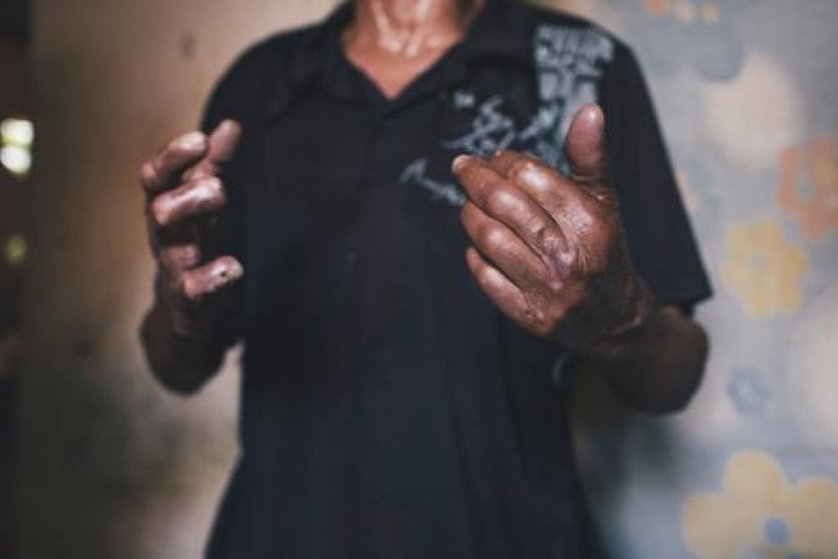 ONU realiza primeira reunião global sobre doenças de pele negligenciadas