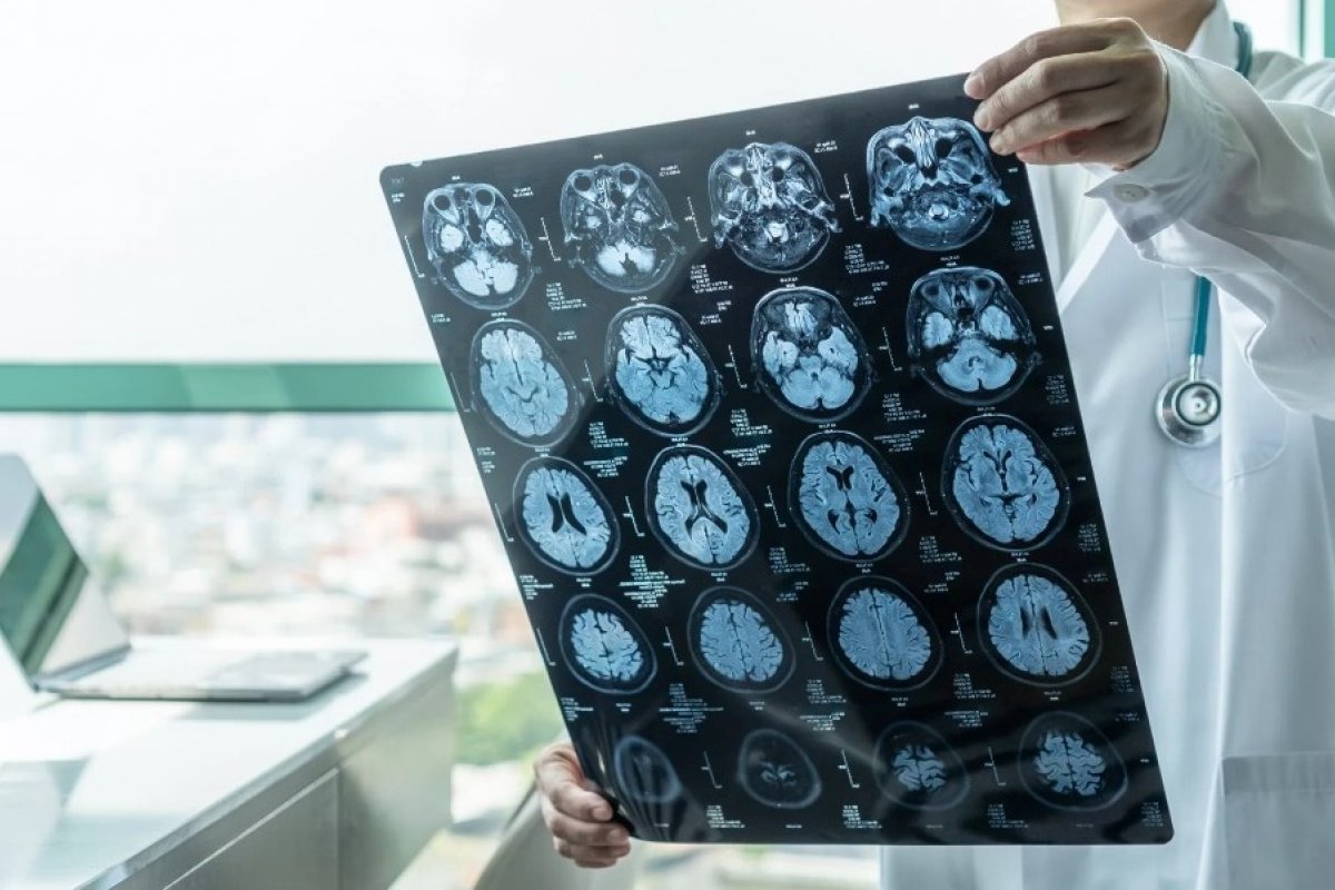 Menopausa precoce pode aumentar o riso de Alzheimer, aponta estudo