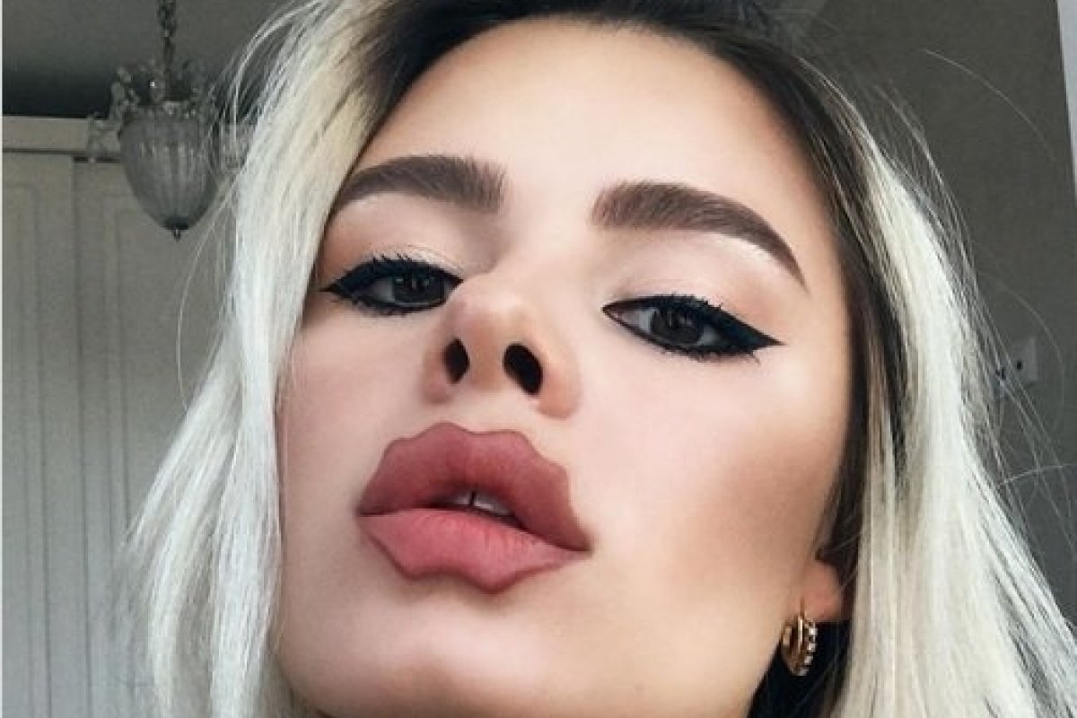 ‘Os lábios do diabo’: confira nova tendência de cirurgia plástica