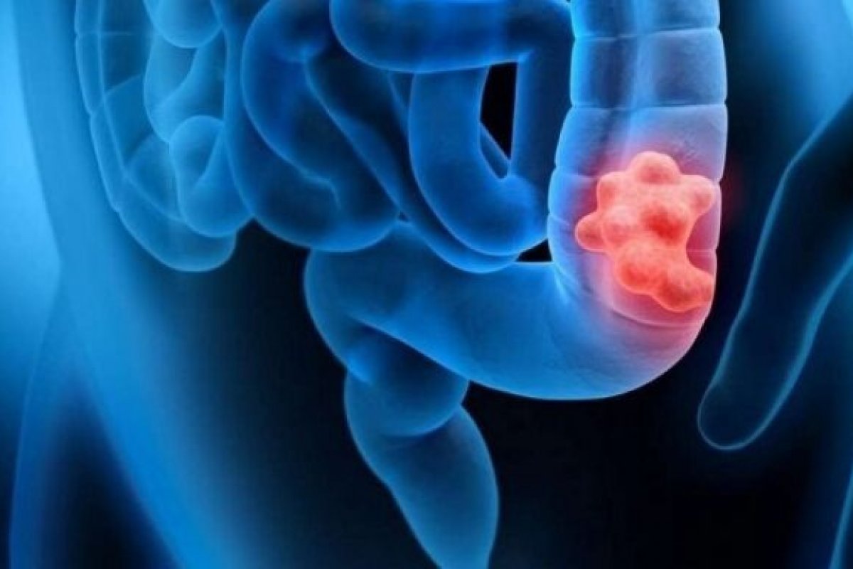 Inteligência artificial pode calcular a probabilidade de uma pessoa sobreviver ao câncer