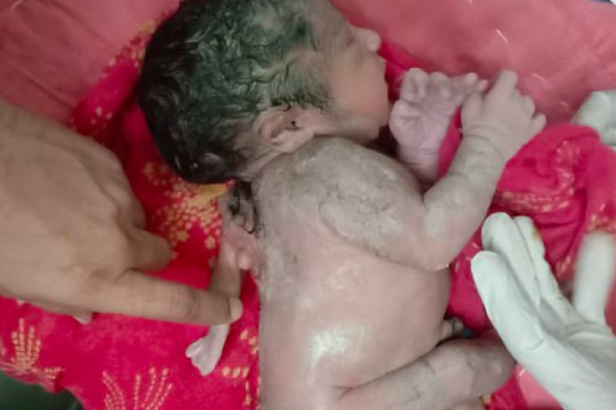Bebê nasce com três mãos em raro caso de polimelia na Índia