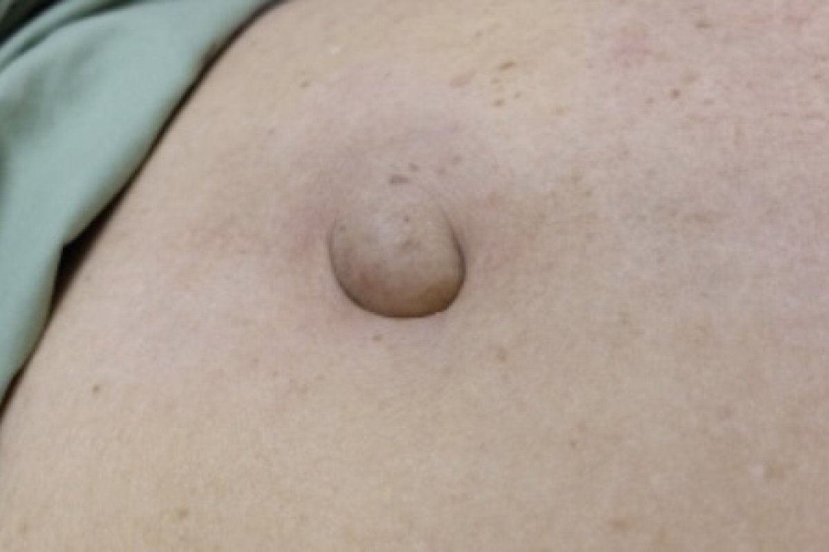 Menos de 1% das cirurgias de hérnias abdominais feitas no SUS são minimamente invasivas