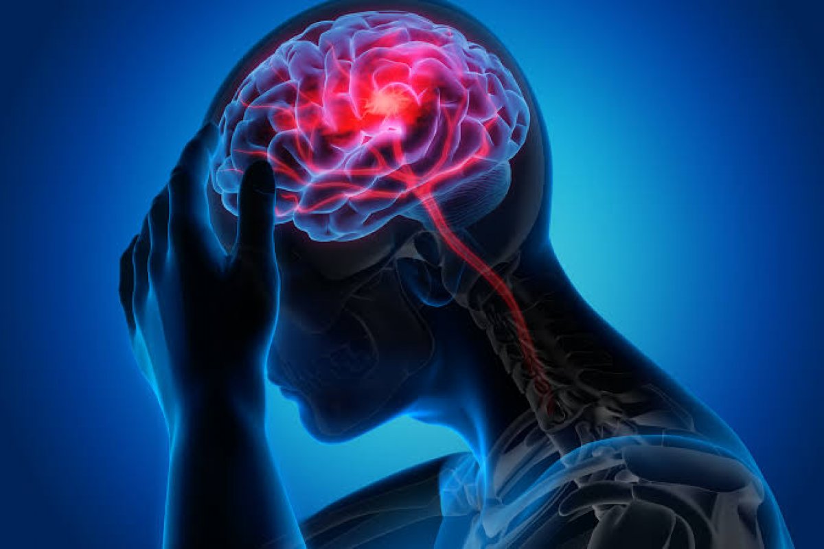 Infartos cerebrais silenciosos: o perigo invisível que pode levar a graves consequências