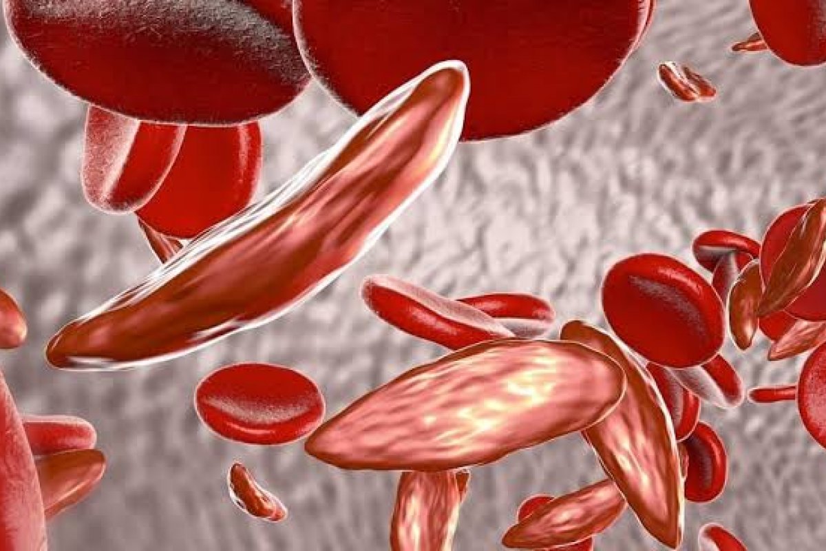 Talassemia: o que é, quais os sintomas, diagnóstico e tratamento!