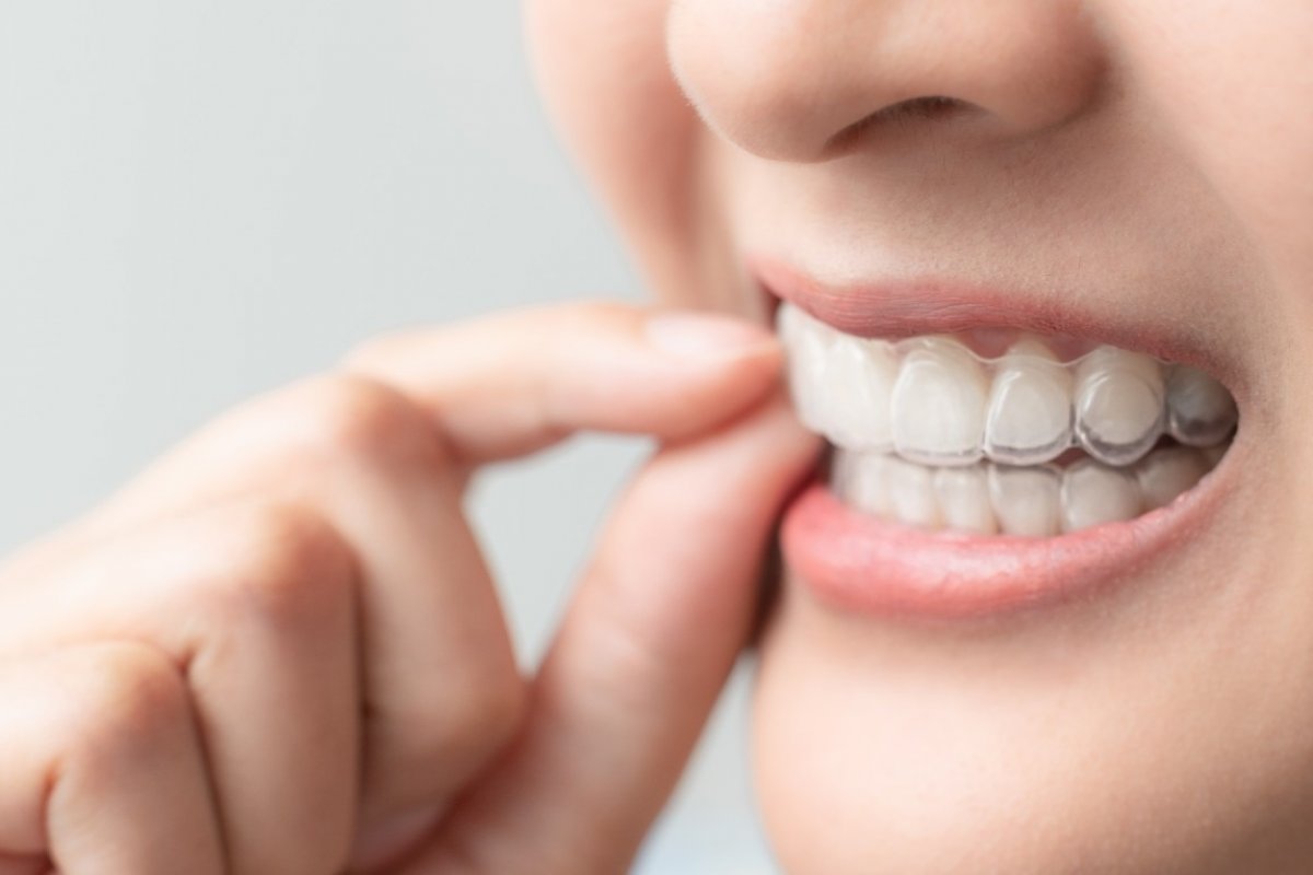 Alinhador invisível ou lentes de contato dentárias: qual é a melhor solução?