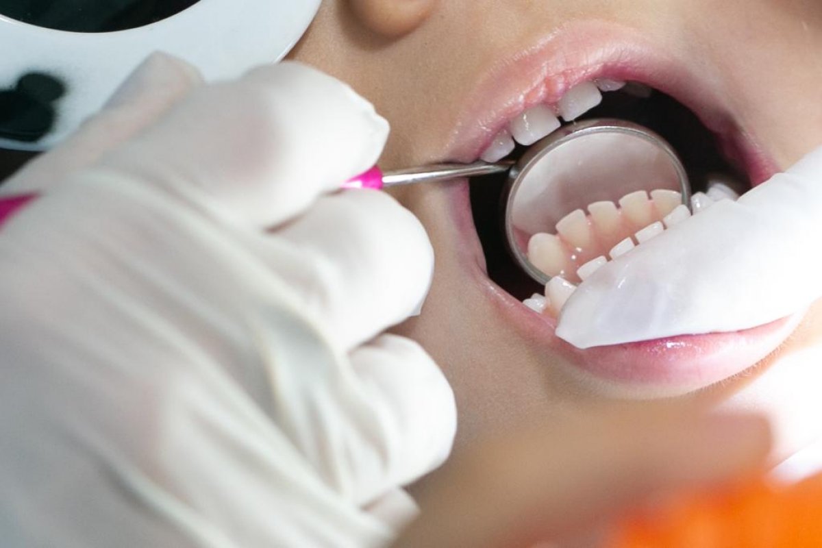 Cárie oculta: o problema é silencioso e pode causar danos irreversíveis nos dentes!