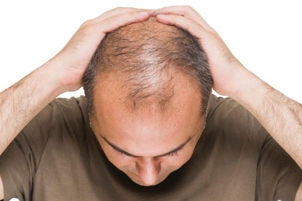 Queda de cabelo atinge 42 milhões de brasileiros: veja como tratar o problema