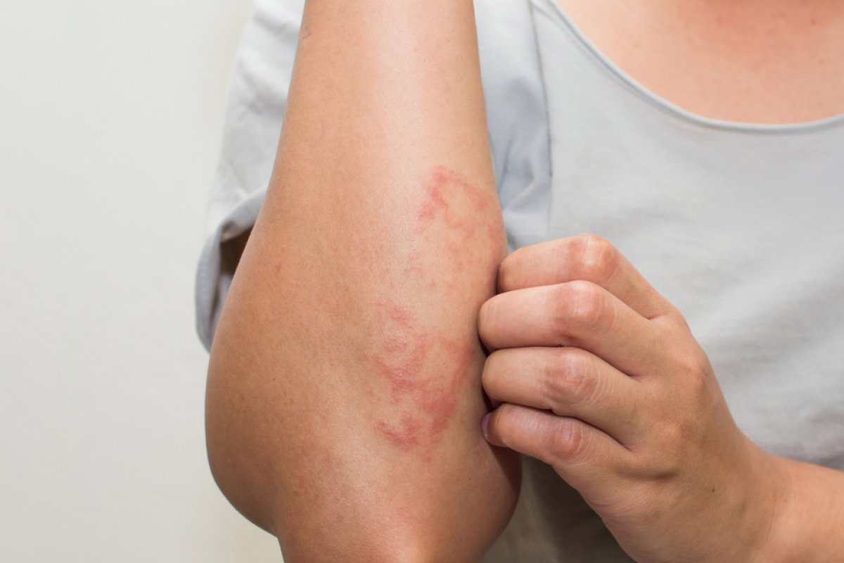 Medicamento para dermatite atópica é liberado pela Anvisa para uso em casos moderados e graves