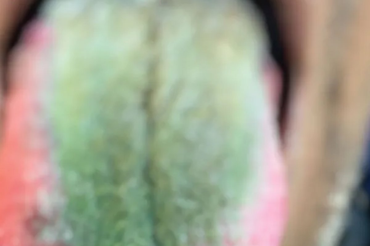 Homem fica com a língua verde e peluda após misturar cigarro com antibiótico