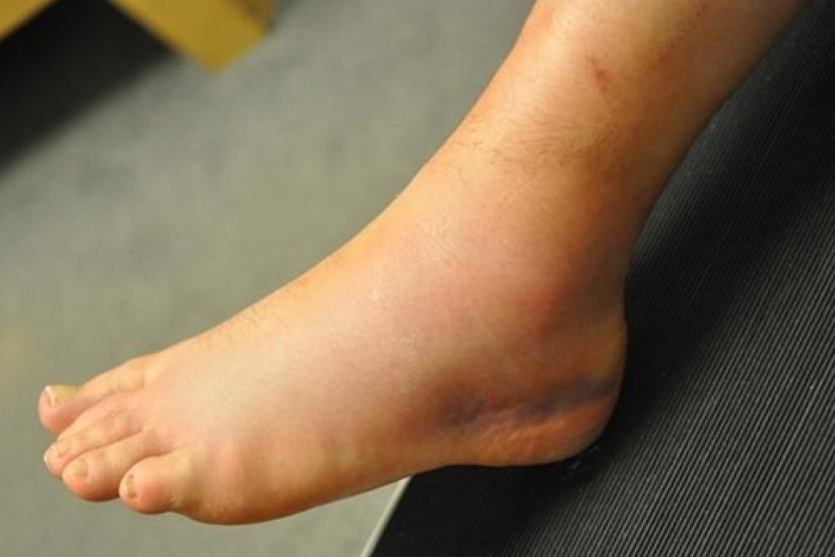 Férias: lesões no tornozelo e pé correspondem a 12% das fraturas pediátricas