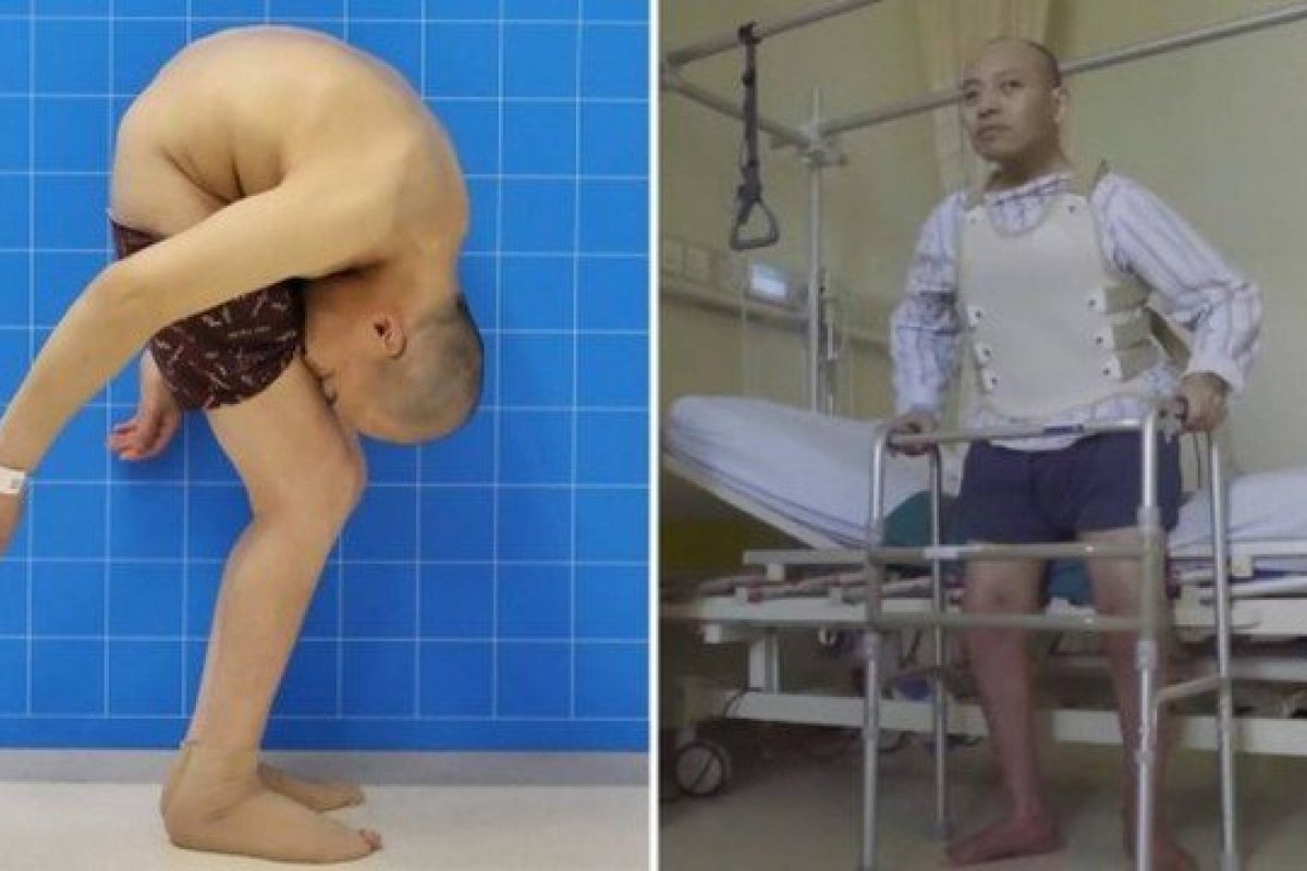 Homem encurvado realiza cirurgia e fica com coluna ereta após 28 anos