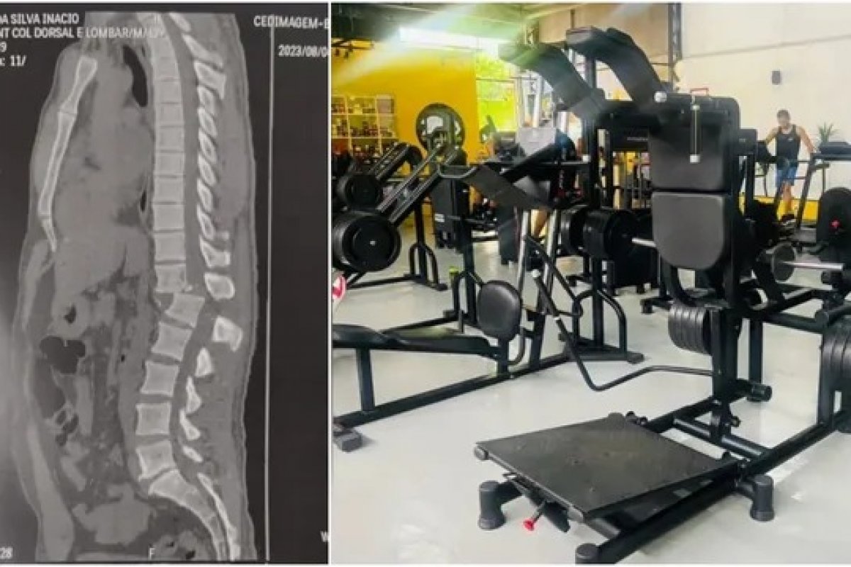 Acidente em academia no Ceará deixa homem com lesão grave na coluna