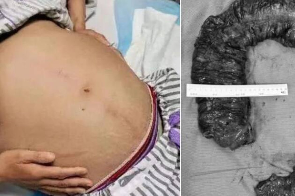 Cerca de 20 kg de fezes acumuladas são retiradas de intestino de mulher